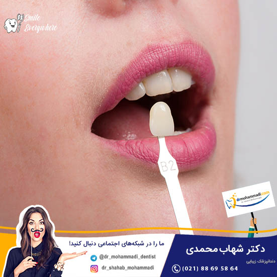 قیمت و هزینه اصلاح طرح لبخند هالیوودی با لمینت سرامیکی - کلینیک دندانپزشکی دکتر شهاب محمدی